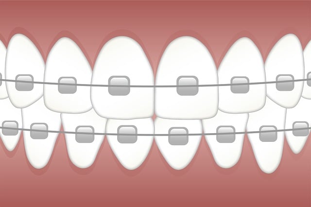 A dental brace with metal braces on it.