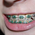 Close-up of a woman's teeth with braces.