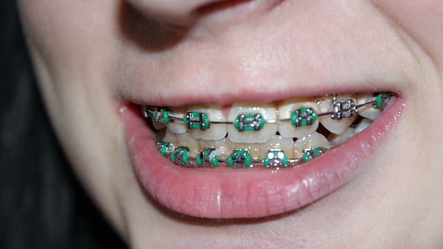 Close-up of a woman's teeth with braces.